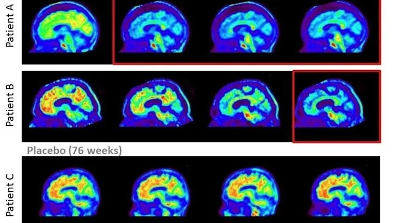 Alzheimer hastalığında yeni umut: Hastalığı yavaşlatmayı başardılar