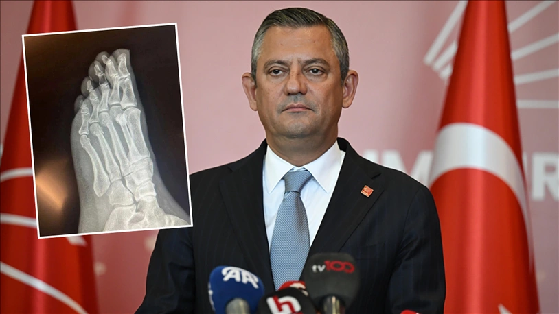 Özgür Özel, ayak röntgenini paylaştı
